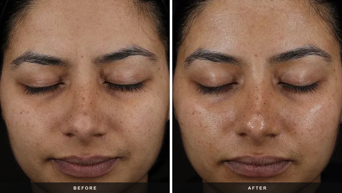 DiamondGlow® Facial