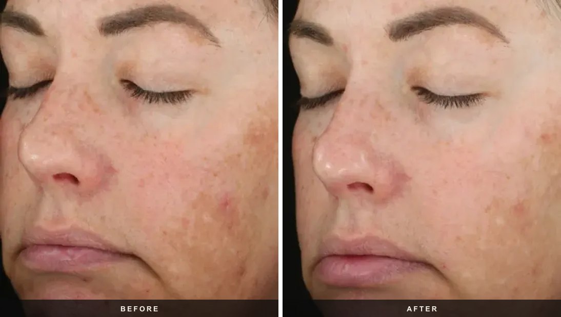 DiamondGlow before and after results at Deluxe Med Spa