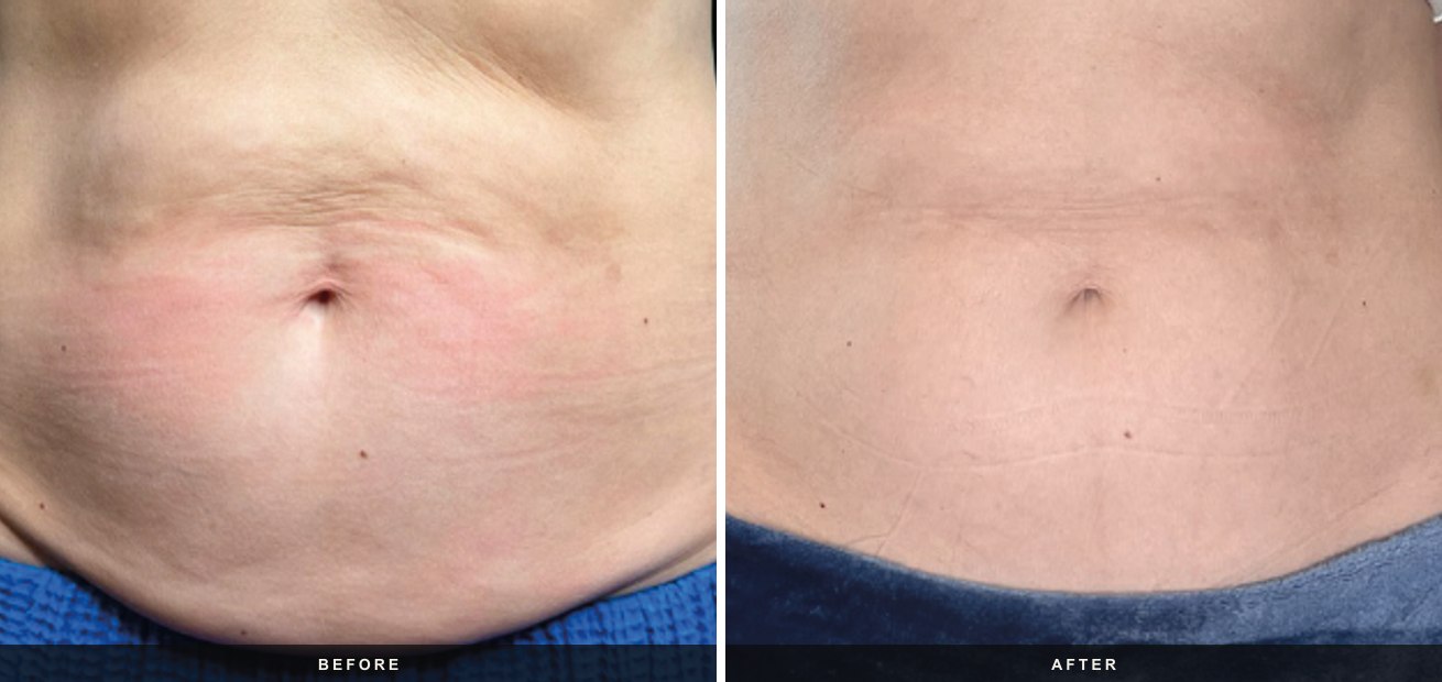 Emsculpt Neo before and after results at Deluxe Med Spa
