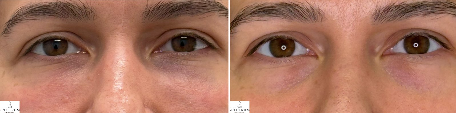 EZ PRF before and after results at Deluxe Med Spa