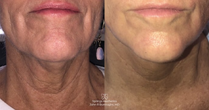 Forma before and after results at Deluxe Med Spa