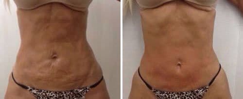 Fotona Laser before and after results at Deluxe Med Spa