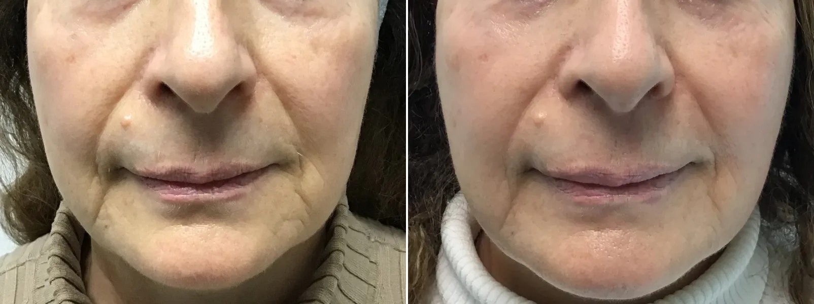 Fotona Laser before and after results at Deluxe Med Spa