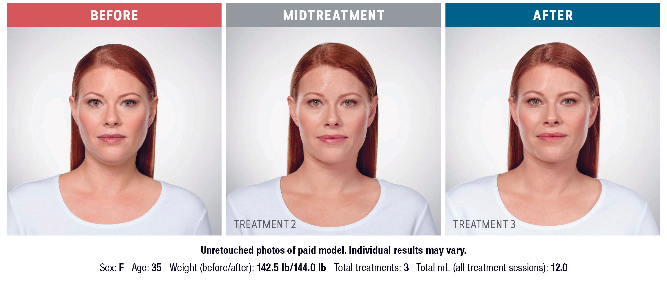 KYBELLA before and after results at Deluxe Med Spa