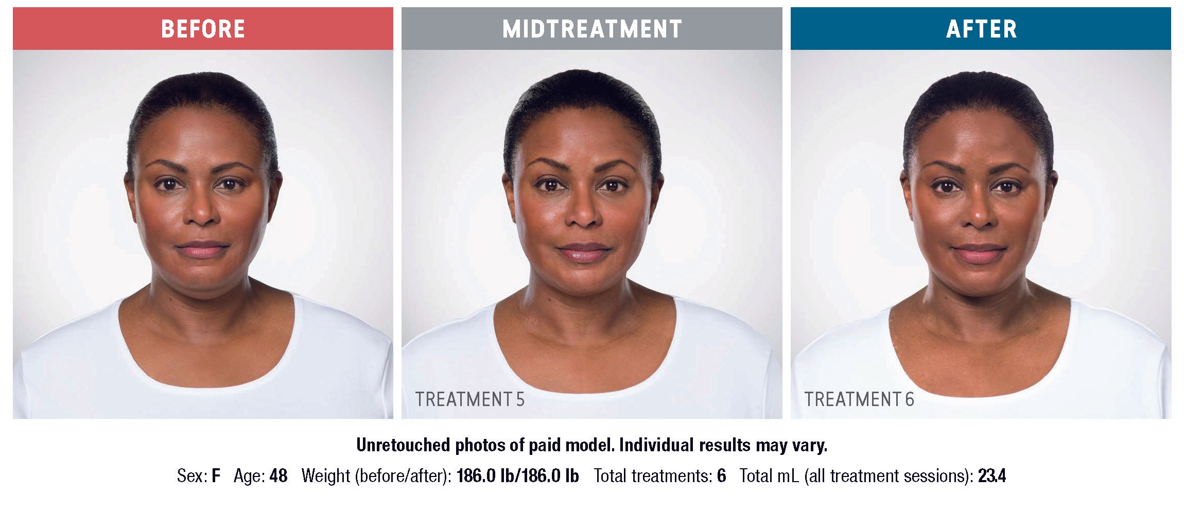 KYBELLA before and after results at Deluxe Med Spa