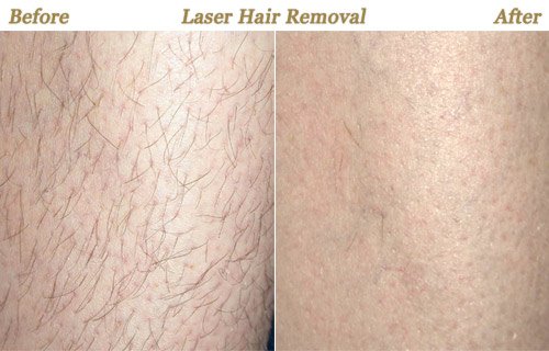 Laser Hair Removal before and after results at Deluxe Med Spa