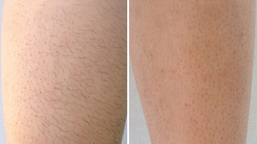 Laser Hair Removal before and after results at Deluxe Med Spa