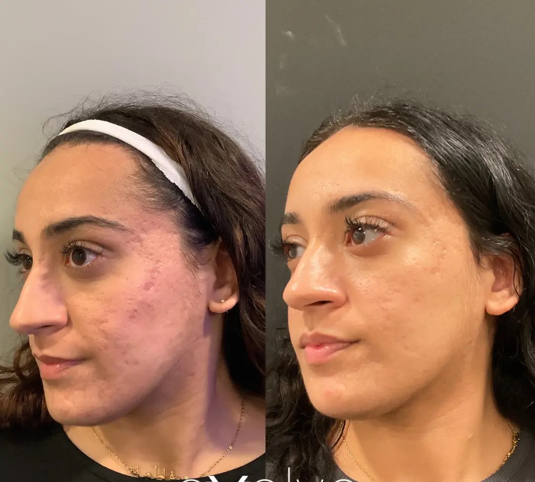 Microneedling with PRP before and after results at Deluxe Med Spa