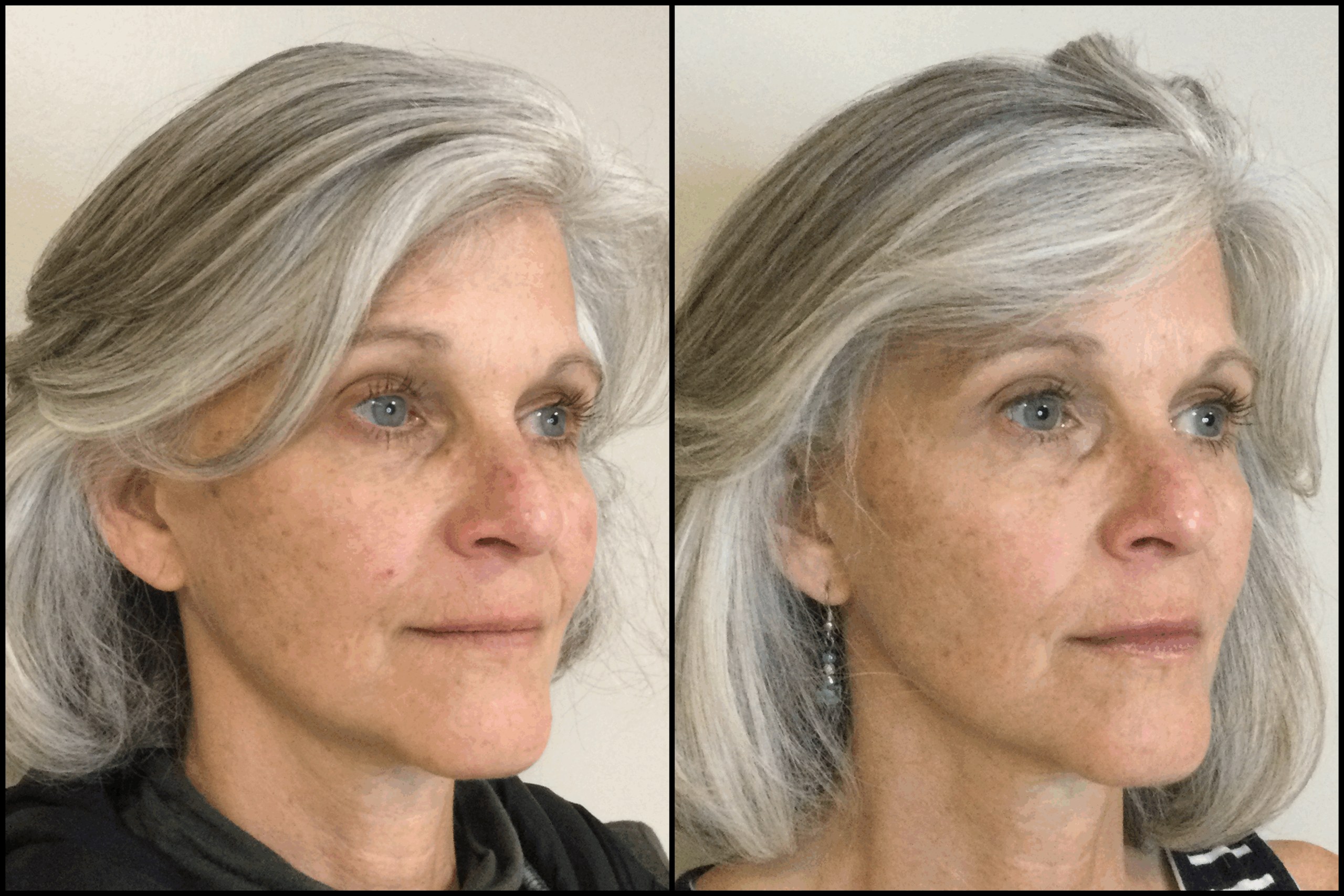 Microneedling with PRP before and after results at Deluxe Med Spa