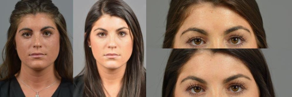 Microneedling with PRP before and after results at Deluxe Med Spa