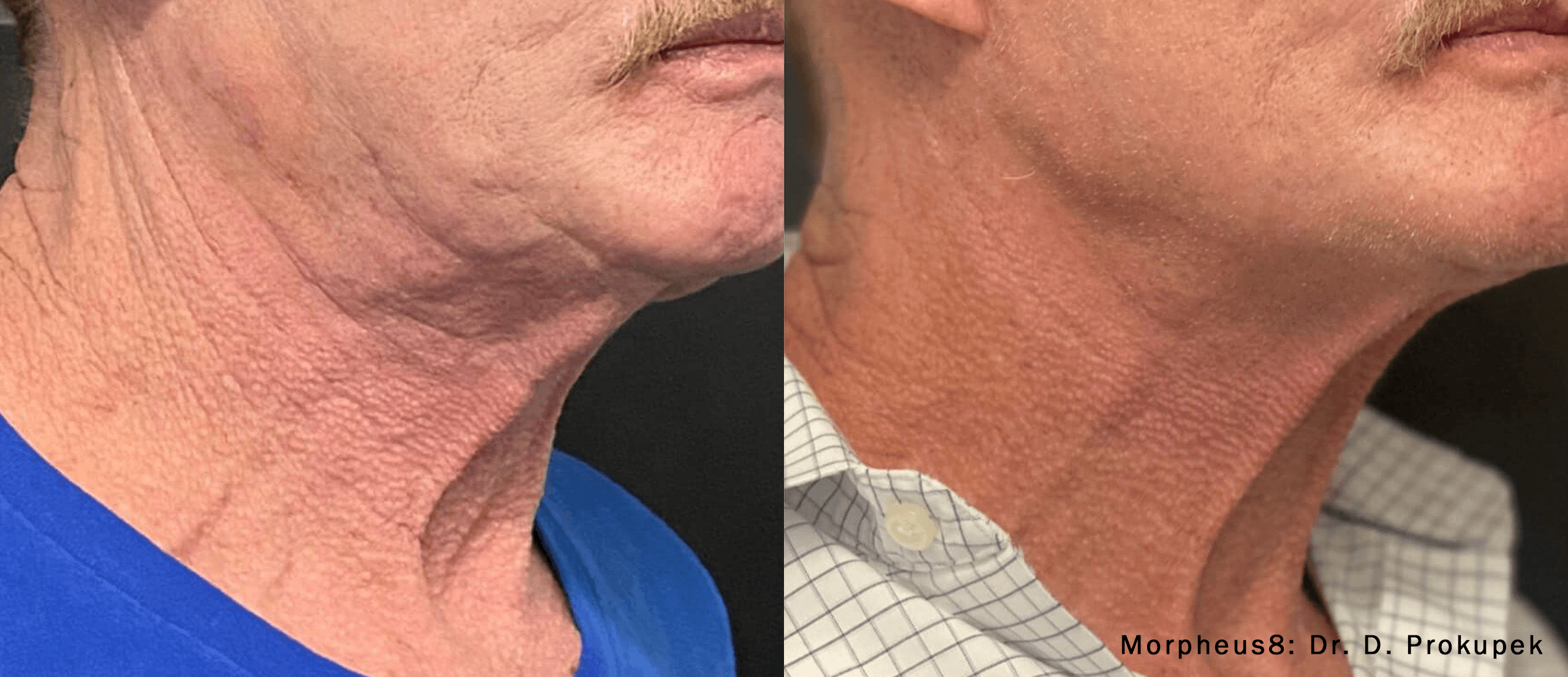 Morpheus8 before and after results at Deluxe Med Spa