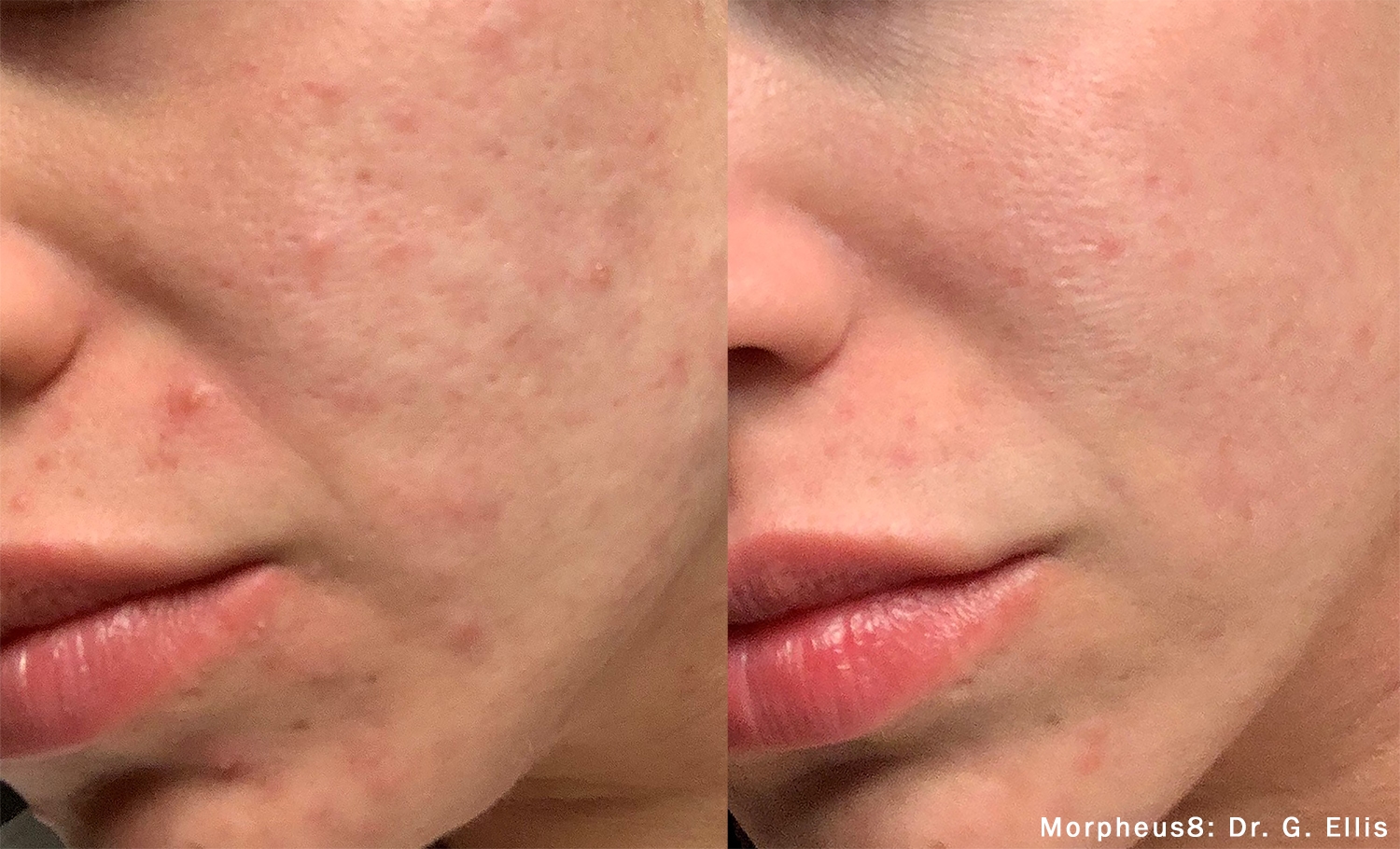 Morpheus8 before and after results at Deluxe Med Spa