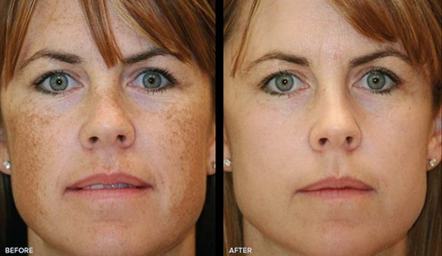Pigmentation Treatment before and after results at Deluxe Med Spa