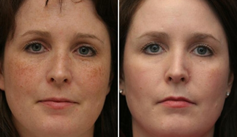 Pigmentation Treatment before and after results at Deluxe Med Spa