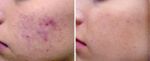 Pore & Acne Treatment before and after results at Deluxe Med Spa