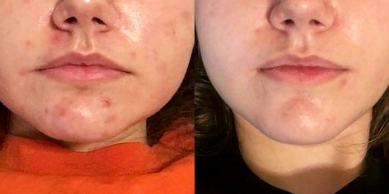 Pore & Acne Treatment before and after results at Deluxe Med Spa