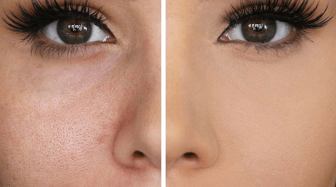 Pore & Acne Treatment before and after results at Deluxe Med Spa