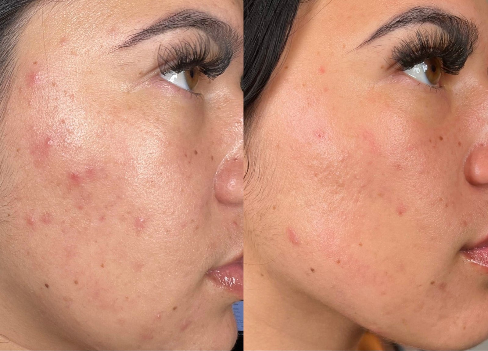 Pore & Acne Treatment before and after results at Deluxe Med Spa