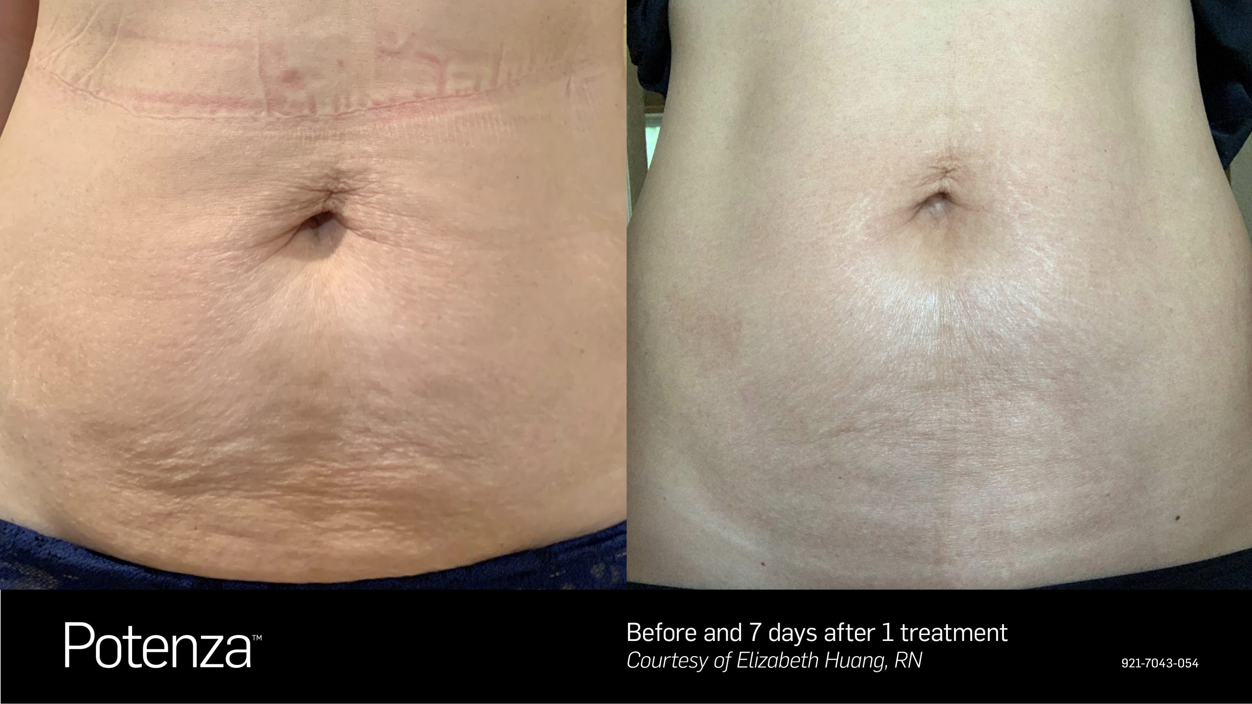 Potenza before and after results at Deluxe Med Spa