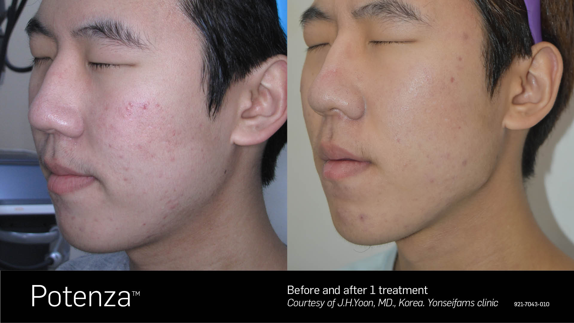 Potenza before and after results at Deluxe Med Spa