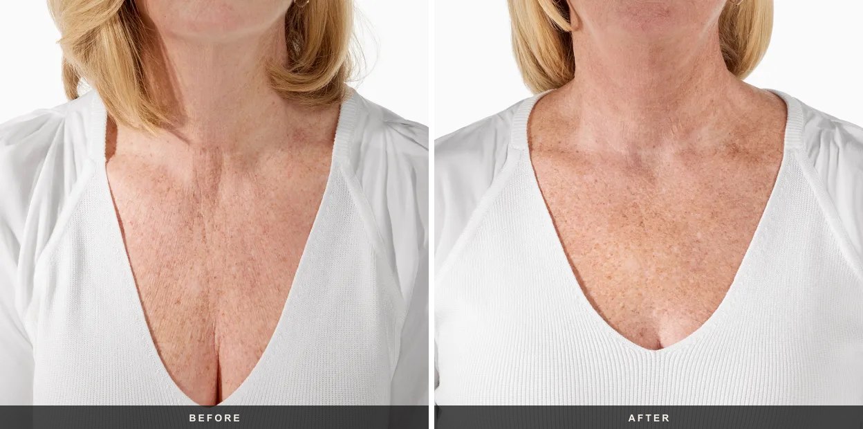 RADIESSE before and after results at Deluxe Med Spa