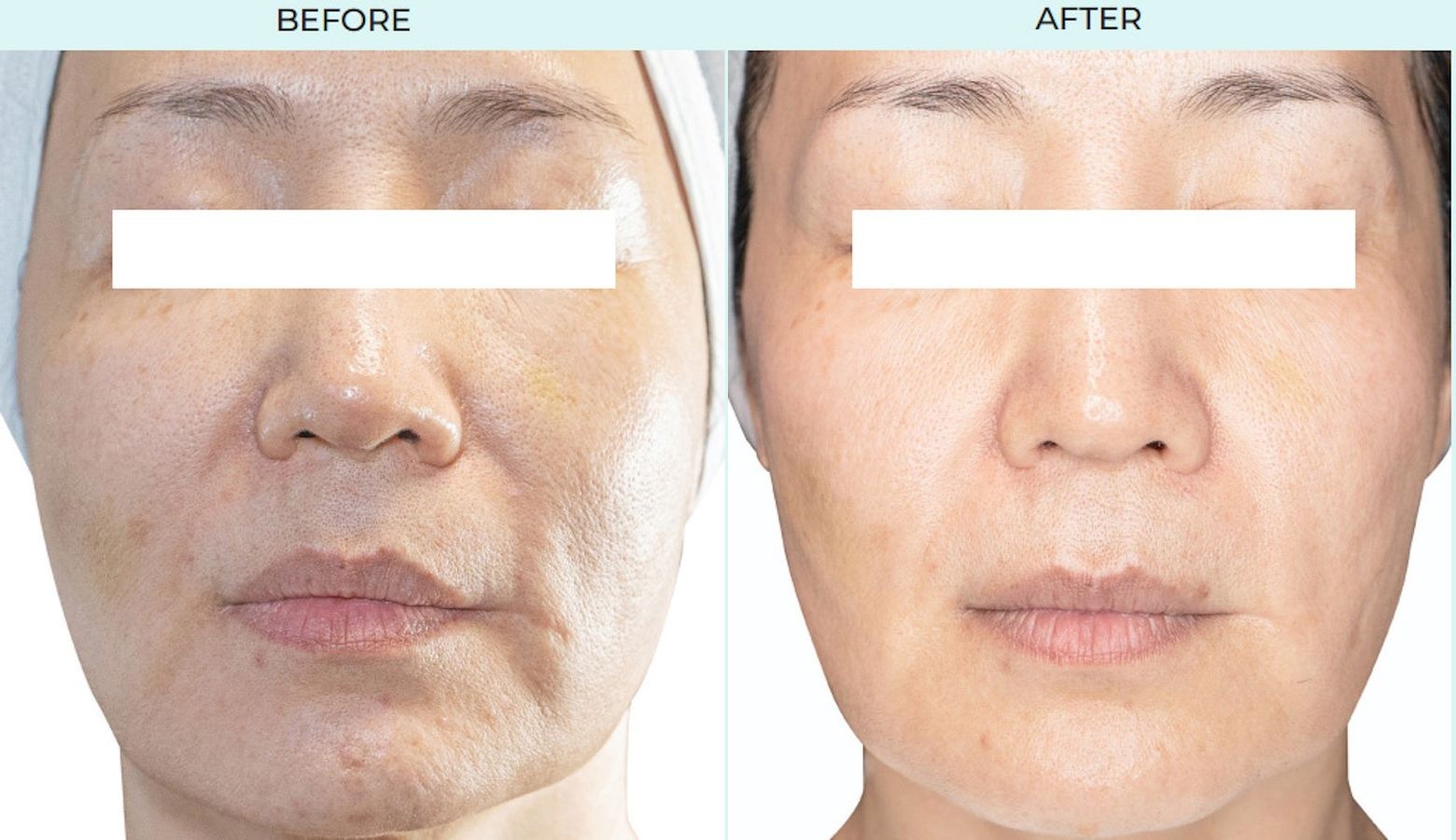 Rejuran before and after results at Deluxe Med Spa