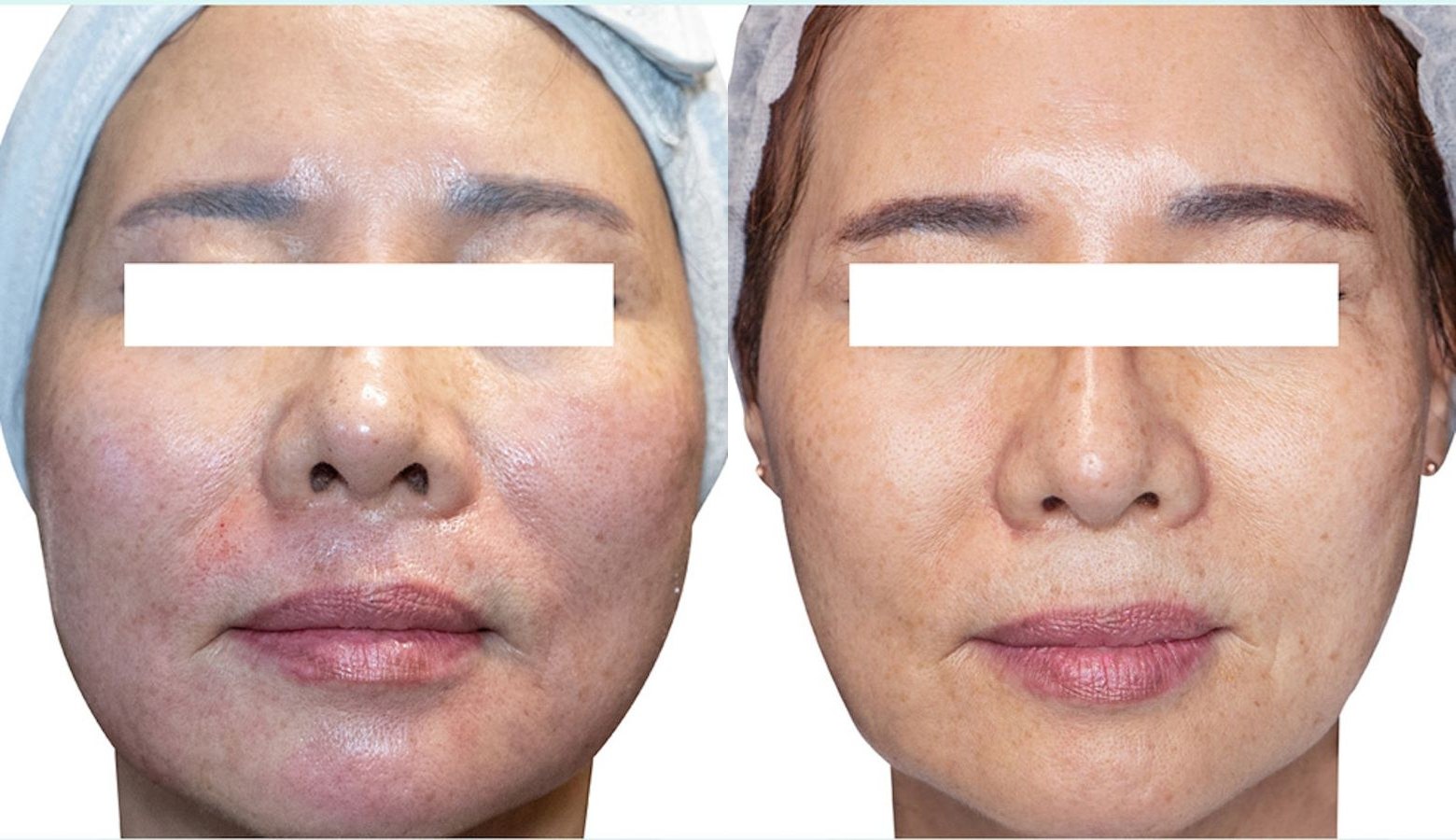 Rejuran before and after results at Deluxe Med Spa