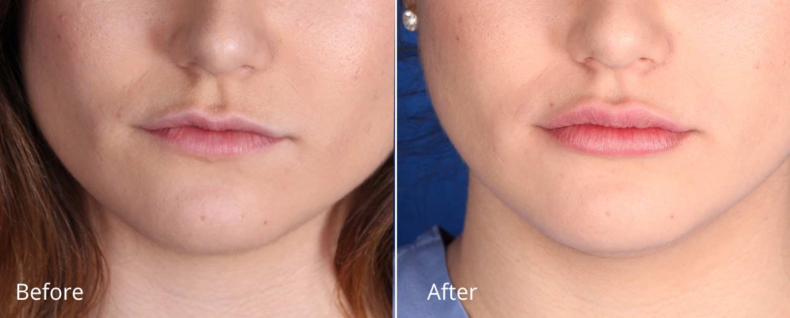 Restylane before and after results at Deluxe Med Spa