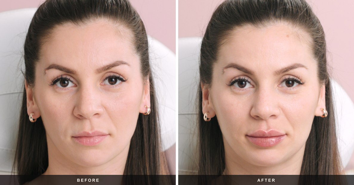 Restylane before and after results at Deluxe Med Spa
