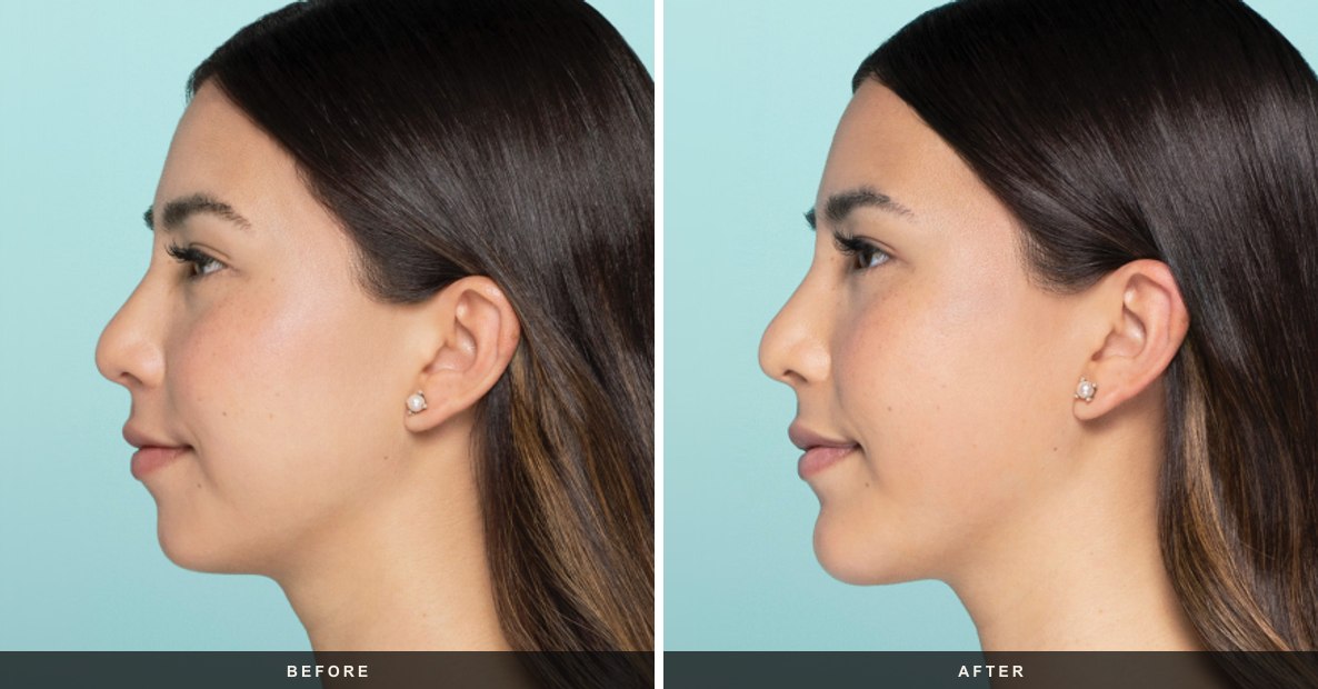 Restylane before and after results at Deluxe Med Spa