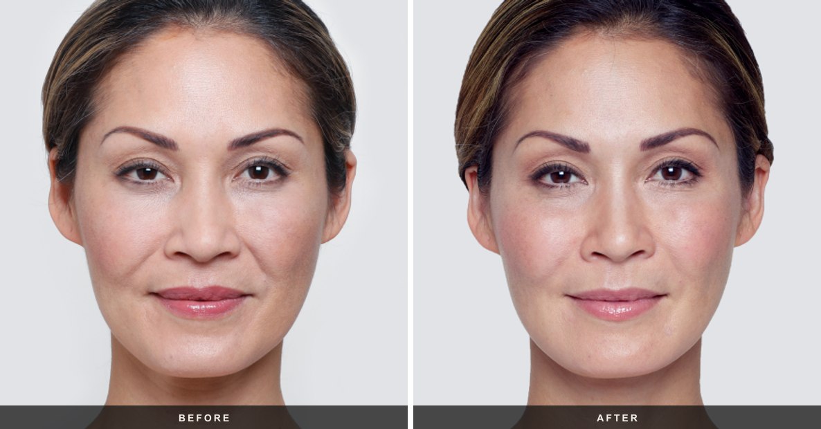 Restylane before and after results at Deluxe Med Spa