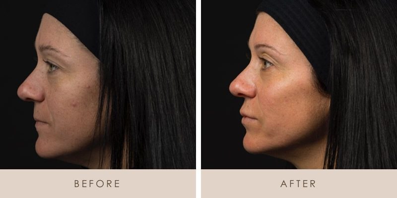 Signature Facial before and after results at Deluxe Med Spa