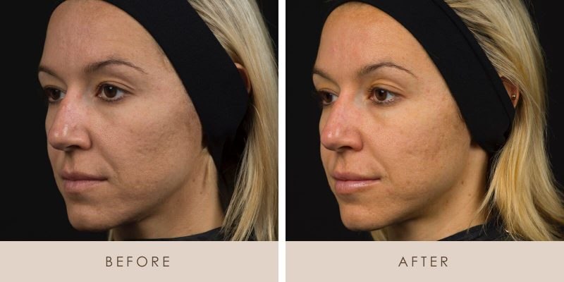 Signature Facial before and after results at Deluxe Med Spa