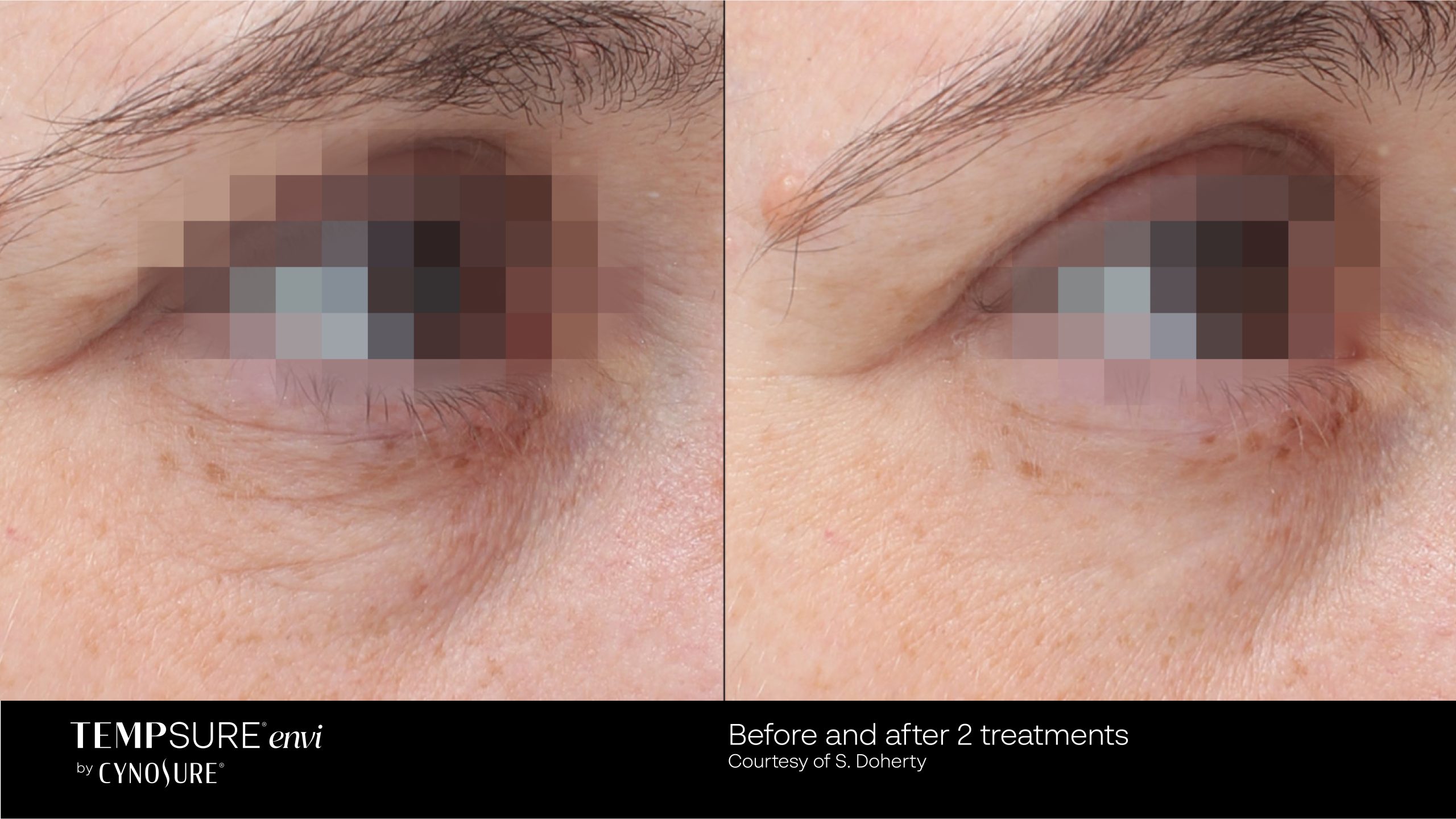 TempSure before and after results at Deluxe Med Spa