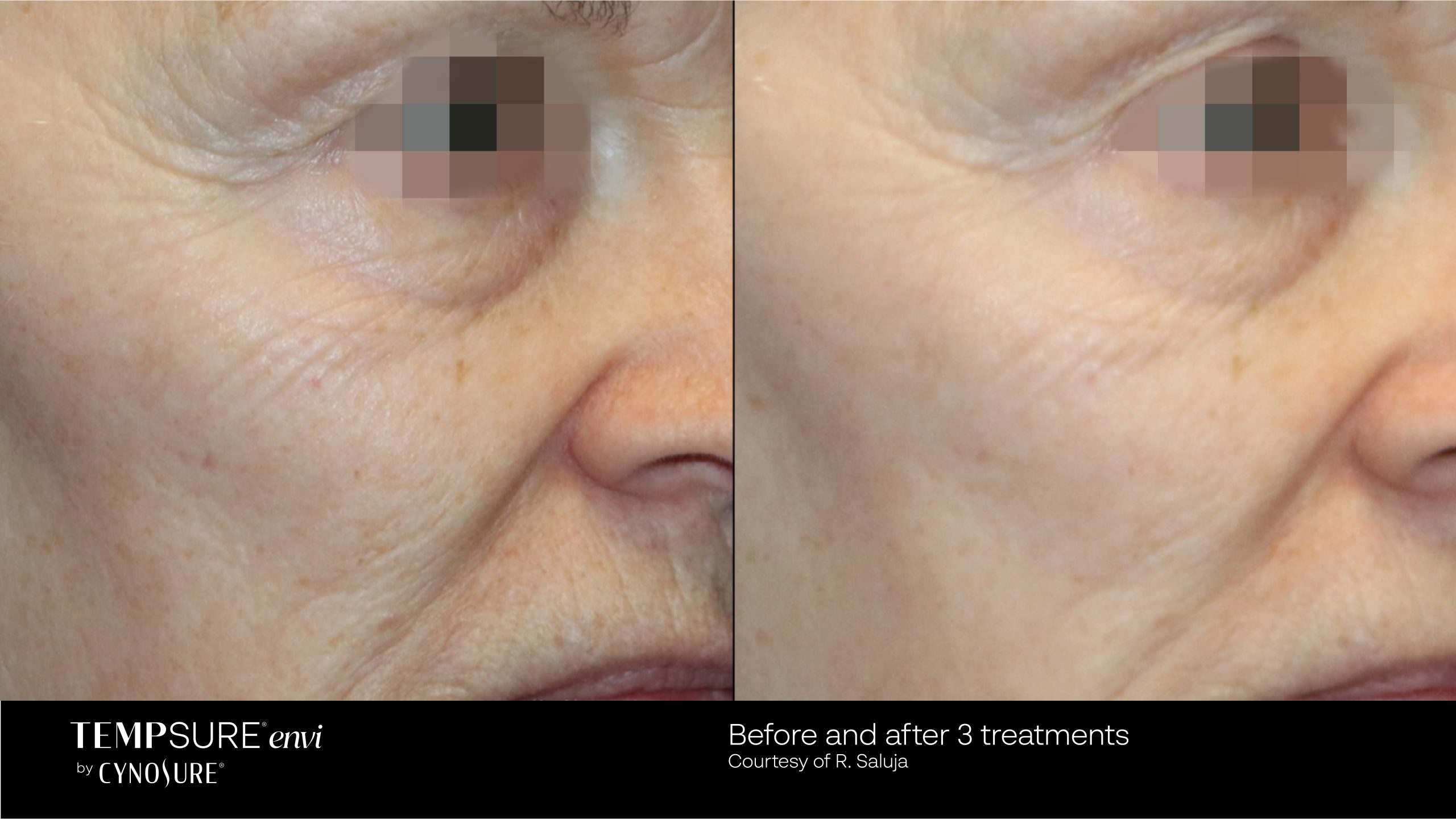 TempSure before and after results at Deluxe Med Spa