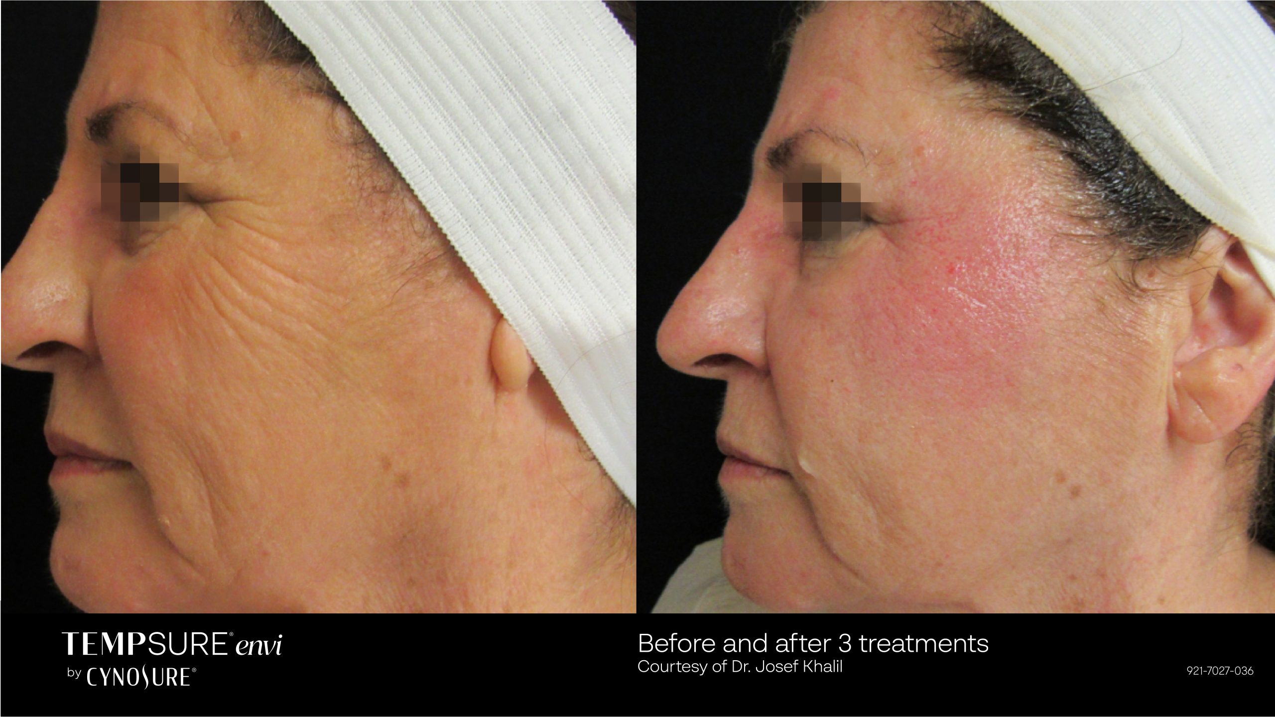 TempSure before and after results at Deluxe Med Spa