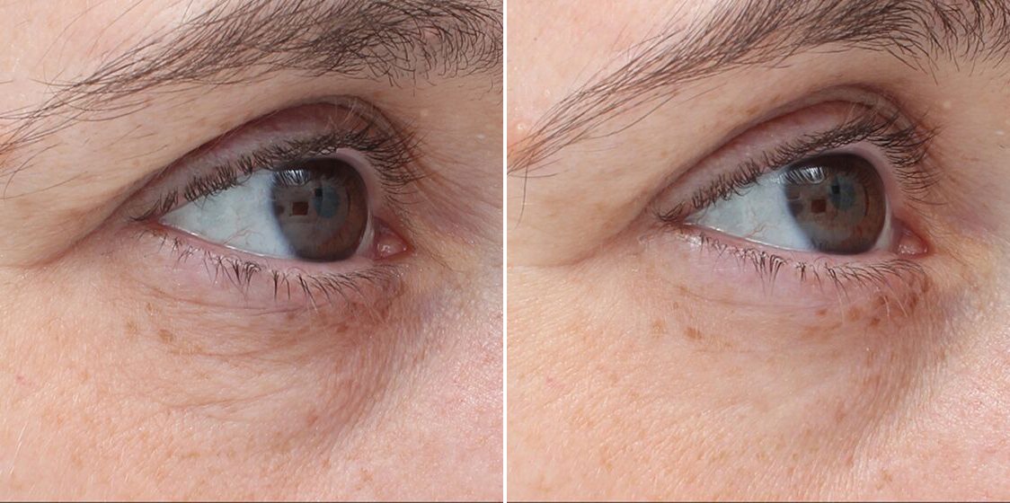 TempSure before and after results at Deluxe Med Spa