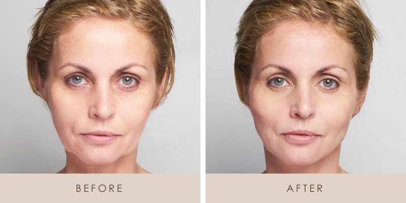 Thread Lift before and after results at Deluxe Med Spa