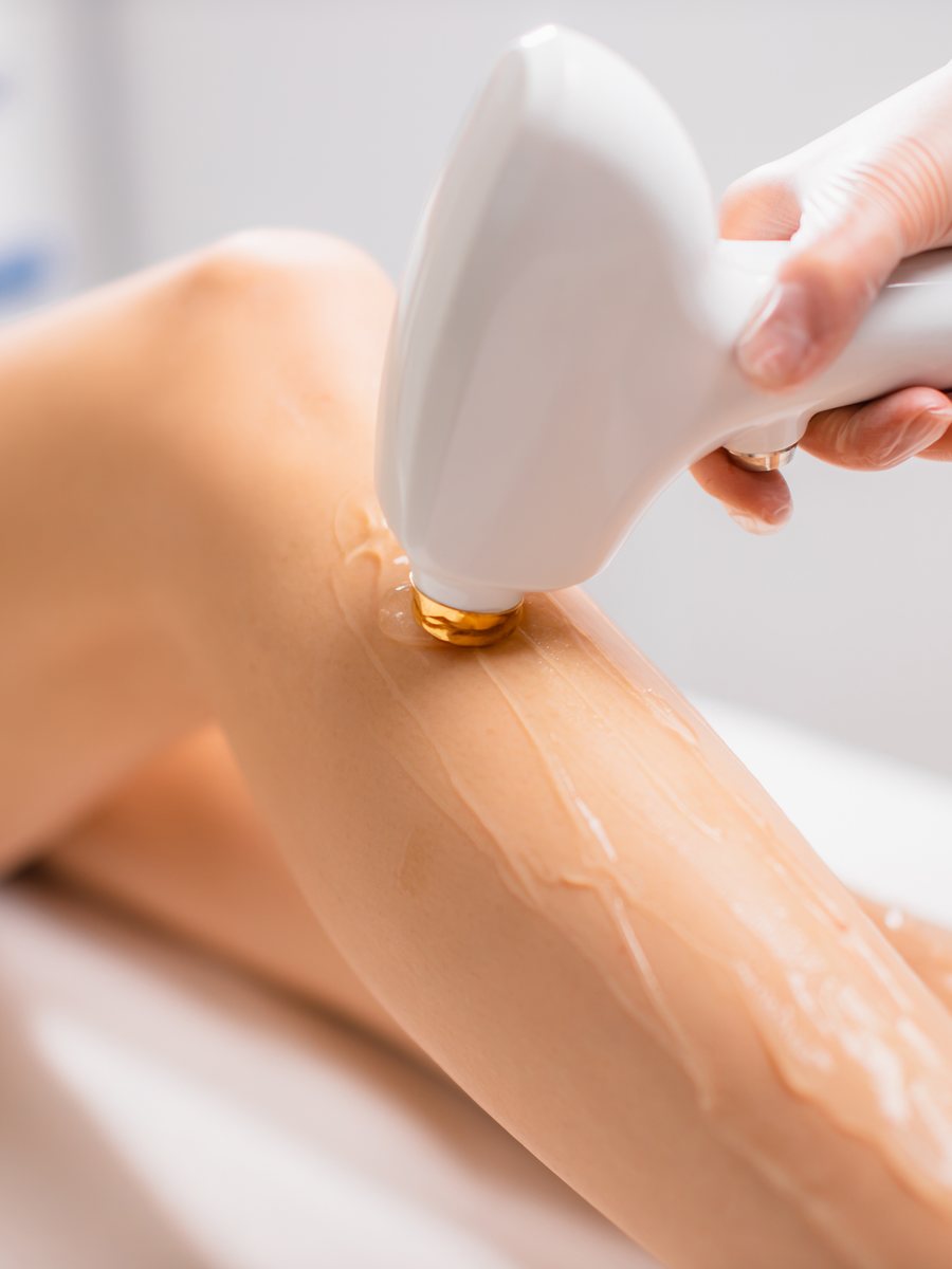 Laser hair removal treatment