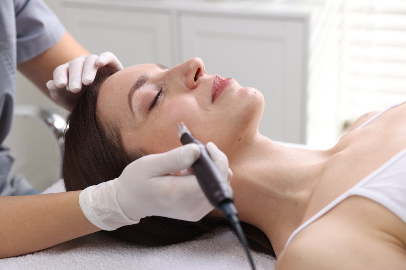 Potenza RF microneedling treatment at Deluxe Med Spa & Wellness
